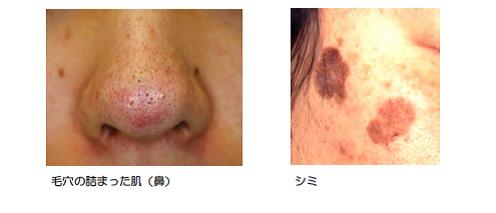 紫外線による肌のダメージを防ぐおすすめコース発表 2016年4月25日　青山ヒフ科クリニック　 http://www.aoyamahihuka.com